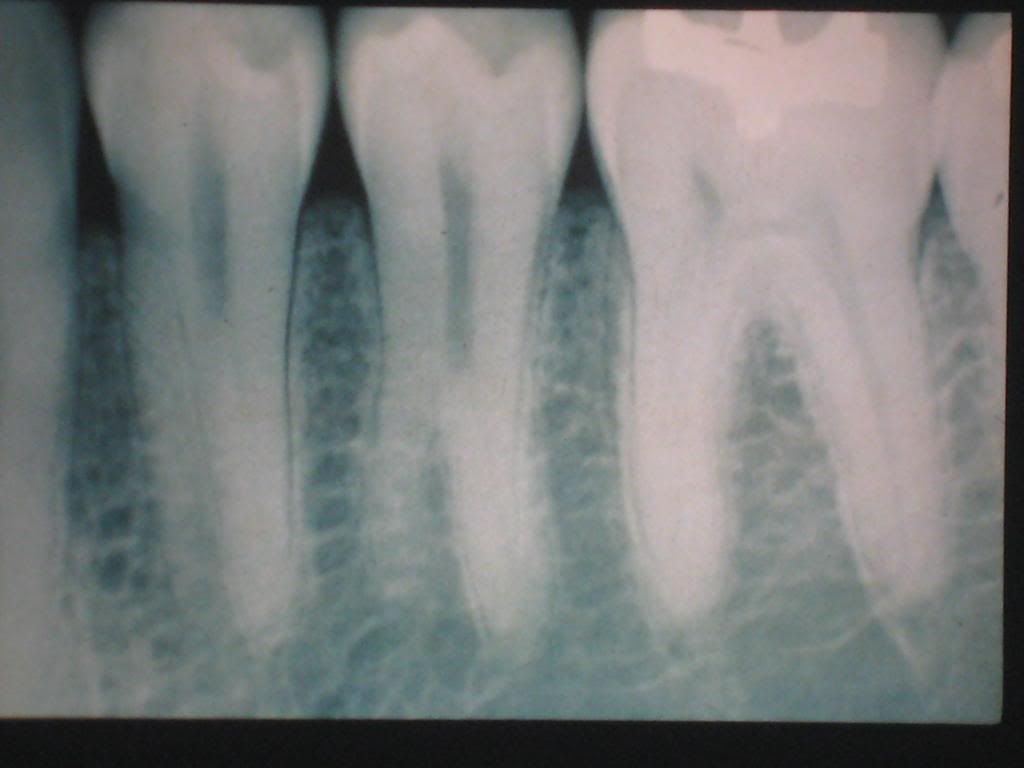 Supernumerary/bifurcated Root Photo by bettinayumul Photobucket